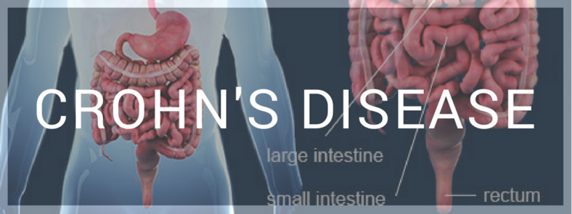 CROHN'S DISEASE